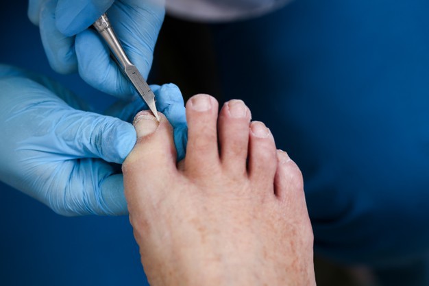 Вросший ноготь на ноге: лечение и профилактика