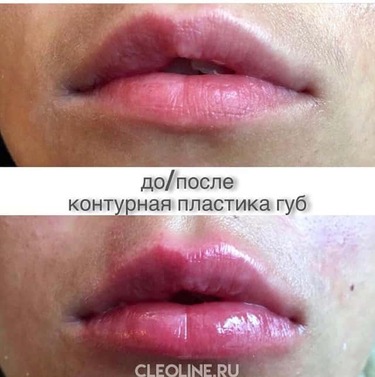 Контурная пластика губ и исправление асимметрии