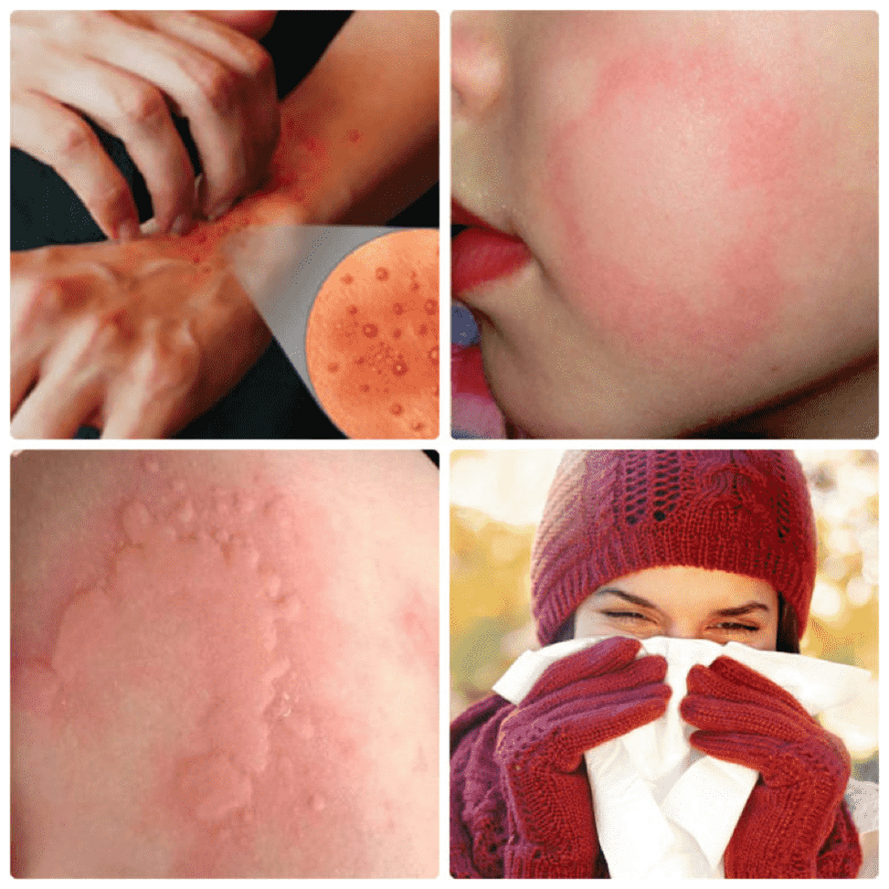 Холодовая аллергия. Что это и как ухаживать за кожей.