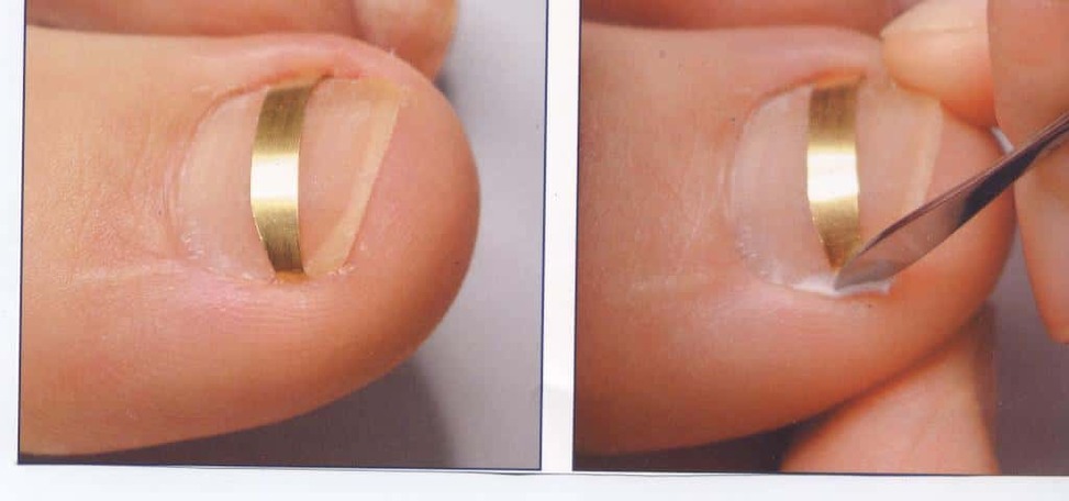 Лечение скрученного ногтя