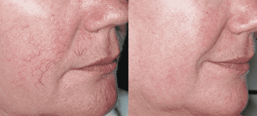 Купероз на лице: причины появления, профилактика и лечение