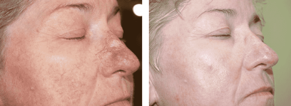 Купероз на лице: причины появления, профилактика и лечение