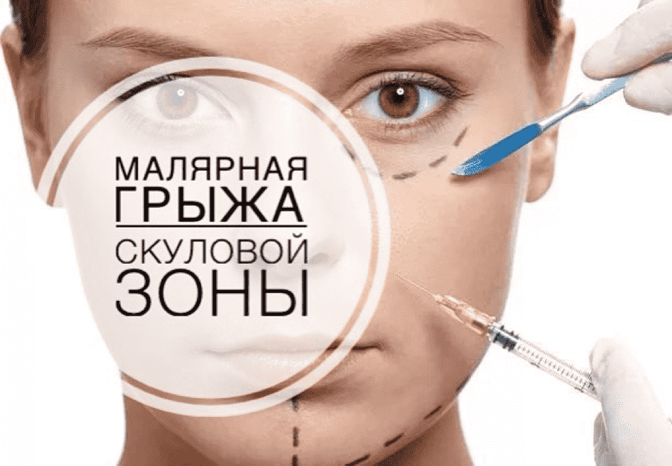 Малярные мешки под глазами: причины появления и способы лечения