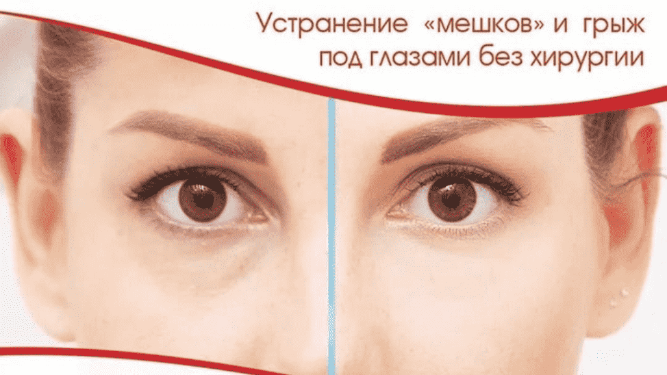 Малярные мешки под глазами: причины появления и способы лечения