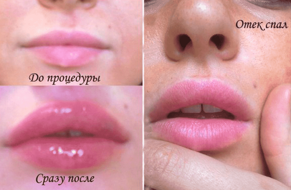 Как снять отек после увеличения губ гиалуроновой кислотой