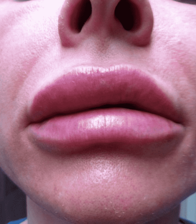 Почему не стоит экономить при контурной пластике губ