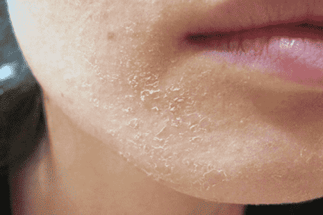 Почему шелушится и сохнет кожа на лице